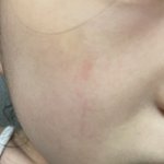 [널리퍼트려] 유명 마스크의 품질 문제로 여자아이 얼굴에 상처가...