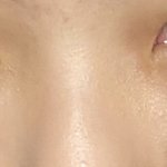 <b>코</b>는 높은데 콧망울이 너무 큼 <b>이런코</b>는 어떤수술해야됨?