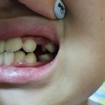 치킨서 나온 <b>나사</b>, 아이 잇몸에 박혀…생니 두개 뽑았다