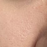 [꼭조언부탁] <b>코</b> <b>옆</b> 모공 심각한가요 25살입니다