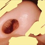 코수술 <b>염증</b>인가ㅜㅜ