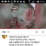 [이것좀봐줘] 뺨에난근육파열 <b>뒷목</b>자상설명 서초견찰서