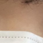 [댓글부탁해] 따끈따끈 쌍수 1일차 후기 사진있음 주의