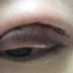 [이것좀봐줘] (혐주의) 쌍수 붓기 원래 이런거야...?