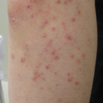 <b>건선</b>? 습진? 암튼 피부 간지러움 심했을 때,,