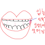 나 입술이랑 <b>잇몸</b> 사이 찢어짐