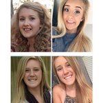 해외 셀럽 치아 교정 전 vs 후