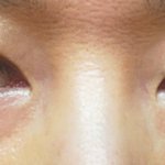 뒤밑트임 8개월후기사진. 세로7mm<b>디귿</b>자, 짝짝이, 30년노안....