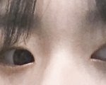 쌍수 3년 된 후기