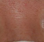 [도와주세요] 일산 <b>OO</b>안과에서 안검하수 수술 했는데 제발 도와주세요