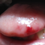 혐주의)혀 깨물었는데 피 어떡해?