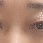 쌍수 1달 후기 객관적 <b>의견</b>부탁드립니다