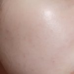 여드름<b>흉터</b> 붉은끼?? 어떻게 하면 없어져??