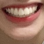 [댓글부탁해] 웃을<b>때</b> 입큰거 진짜 <b>스트레스</b>ㅠㅠㅠ