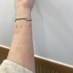 <b>파스</b>를 붙이고 화상을 입었습니다