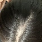 [댓글부탁해] 나 <b>탈모</b> 어떡해ㅋㅋ ㅋ ㅋㅋ.......