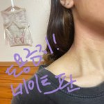 [드루와] [사진有] 이렇게 아토피 때문에 고생하는 사람 있음?...