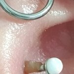 약혐) <b>투이</b>너가 안 아물어