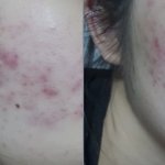나 피부 좀 나아진거같음?? (혐주의