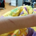 내 팔에 흉터 <b>티</b> 많이 <b>남</b>?