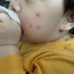 [댓글부탁해] 우리아기 피부 좀 봐주세요ㅠㅠ