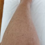 다낭성 <b>난소</b> 증후군  다리털 털사진좀봐주세요