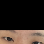 [드루와] 쌍수 + 앞 + <b>뒤트임</b> ㅇㄸ