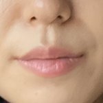 [꼭조언부탁] <b>팔자</b>주름 필러 맞은 후에 입술 두꺼워지는건 뭔가요