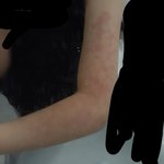 [댓글부탁해] 혐주의 <b>백신</b>맞앗는데 팔 이렇게됨..