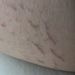 [조언부탁해] 허벅지 <b>안쪽</b> 튼살 레전드