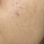 [댓글부탁해] 나 피부 흉터 어떤 편이야?