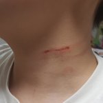 [꼭조언부탁] 목졸린 자국과 목에 5cm 상처로 흉터 남는다는데...
