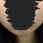 [드루와] 턱보톡스 후기알려줌