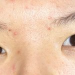 [댓글부탁해] 나 쌍수후기 볼사람