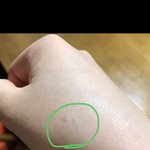 나 너무 무섭고 급해 이거 <b>백신</b> 부작용 맞아?? 사진 있어