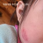 얼굴이 괴사 되었습니다. 제발도와주세요(사진첨부)국민<b>청원</b> 진행중