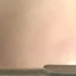 나만 여드름나면 코옆에 <b>대칭</b>으로 남?