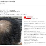 현시각 탈모갤 조회수 <b>폭발</b>한 글