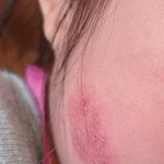 여아 얼굴 괴사 사건 가족 입장문입니다