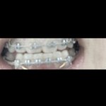 교정9개월<b>차</b> <b>입</b>툭튀없어지고 ㅈㄴ가지런해짐