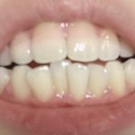 [댓글부탁해] 나 교정 해야해 ? (<b>누렁</b>니임 혐짤)