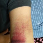 나 옛날에 넘어져서 멍든 거 보고 <b>갈래</b>?