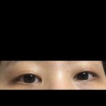 얘들아 나 이거 다래끼임??? ㅠㅠㅠㅠㅠㅠㅠ