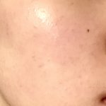 [댓글부탁해] 좁쌀여드름 <b>박멸</b>한 템,꿀팁 공유함 (사진O)