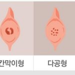 [19] 혹시 처녀막(질근육) <b>칸막이</b>형인 사람있어..?