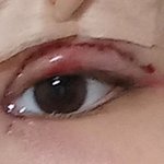 오늘 쌍수 하고왔어