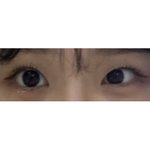 [드루와] 나 쌍수 + <b>눈매</b>교정 개개개개개망한듯