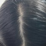 <b>탈모</b> 괜찮아진거같음????? 사진