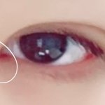 [댓글부탁해] 나 오늘 쌍수 2주찬데 이거 뭐야..?