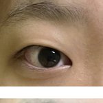 와 쌍수 <b>전후</b> 봐